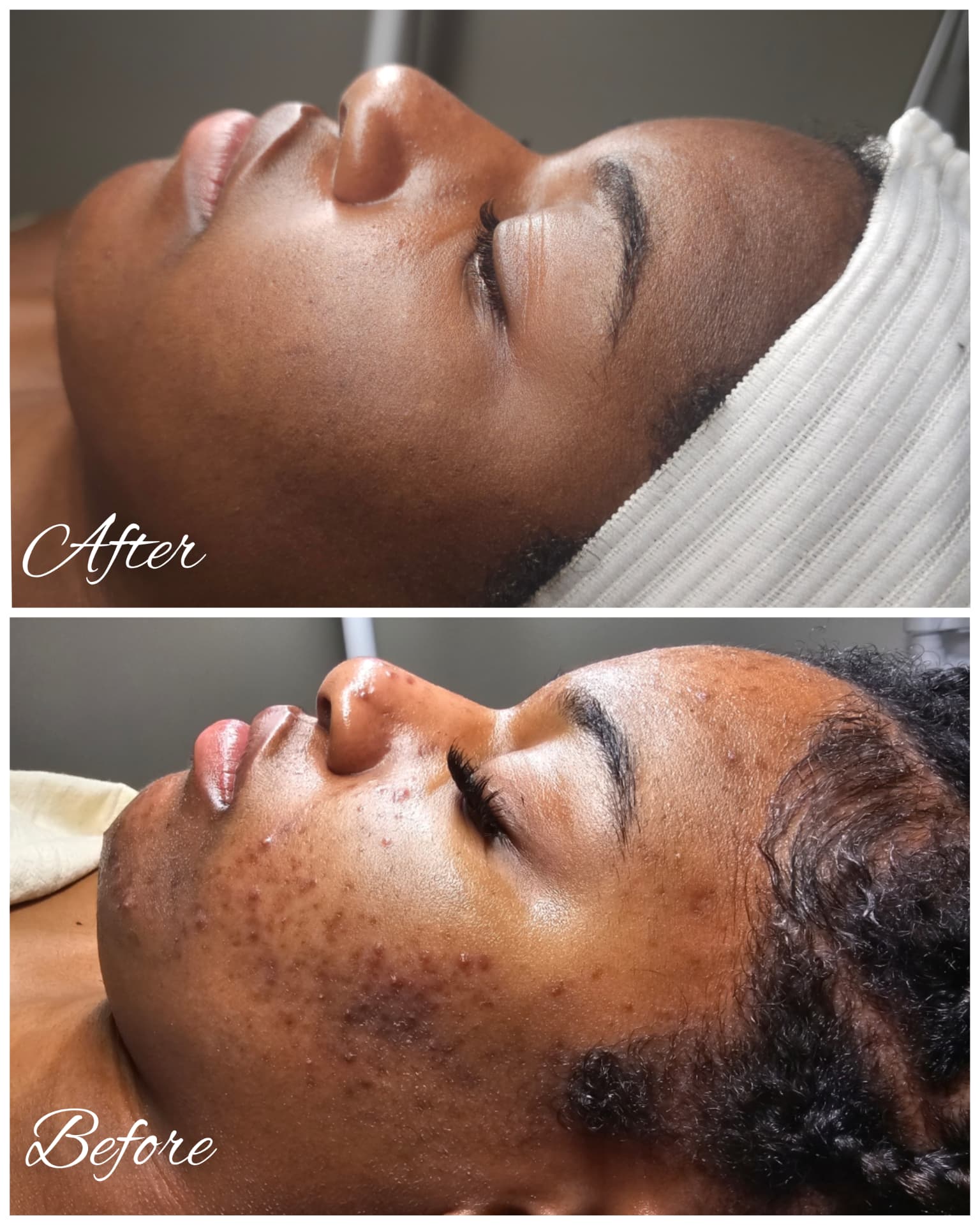 Client acne and pigmentation progress shown from a side profile before and after treatment
