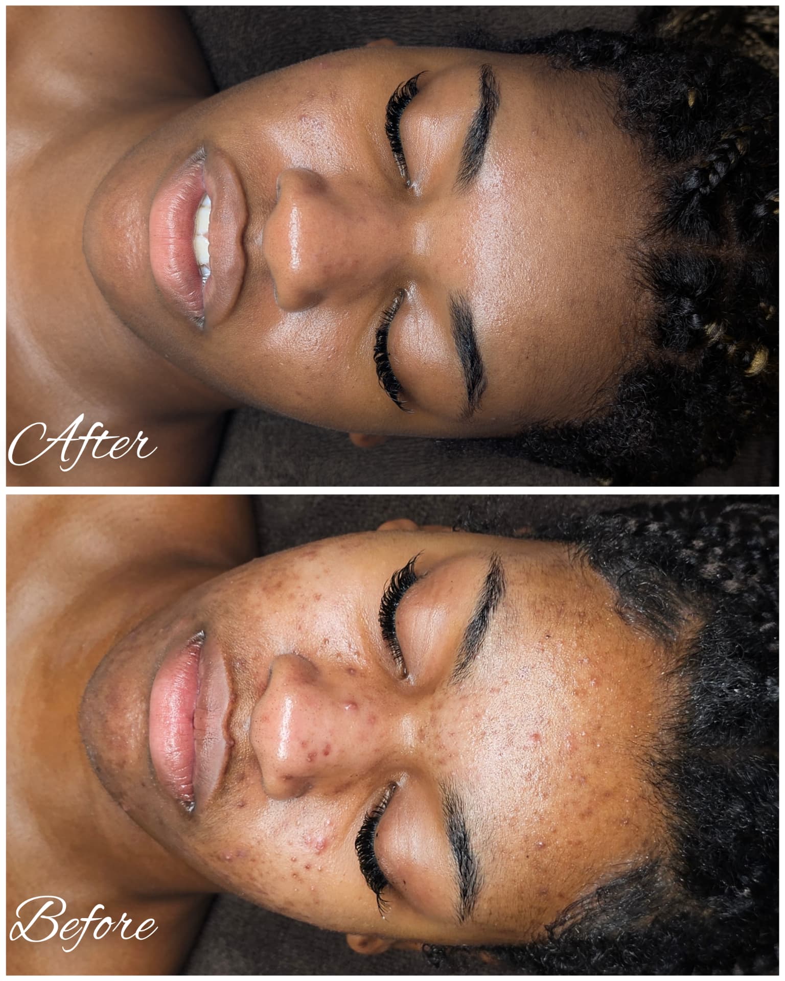 Client acne and skin texture progress shown from above before and after treatment